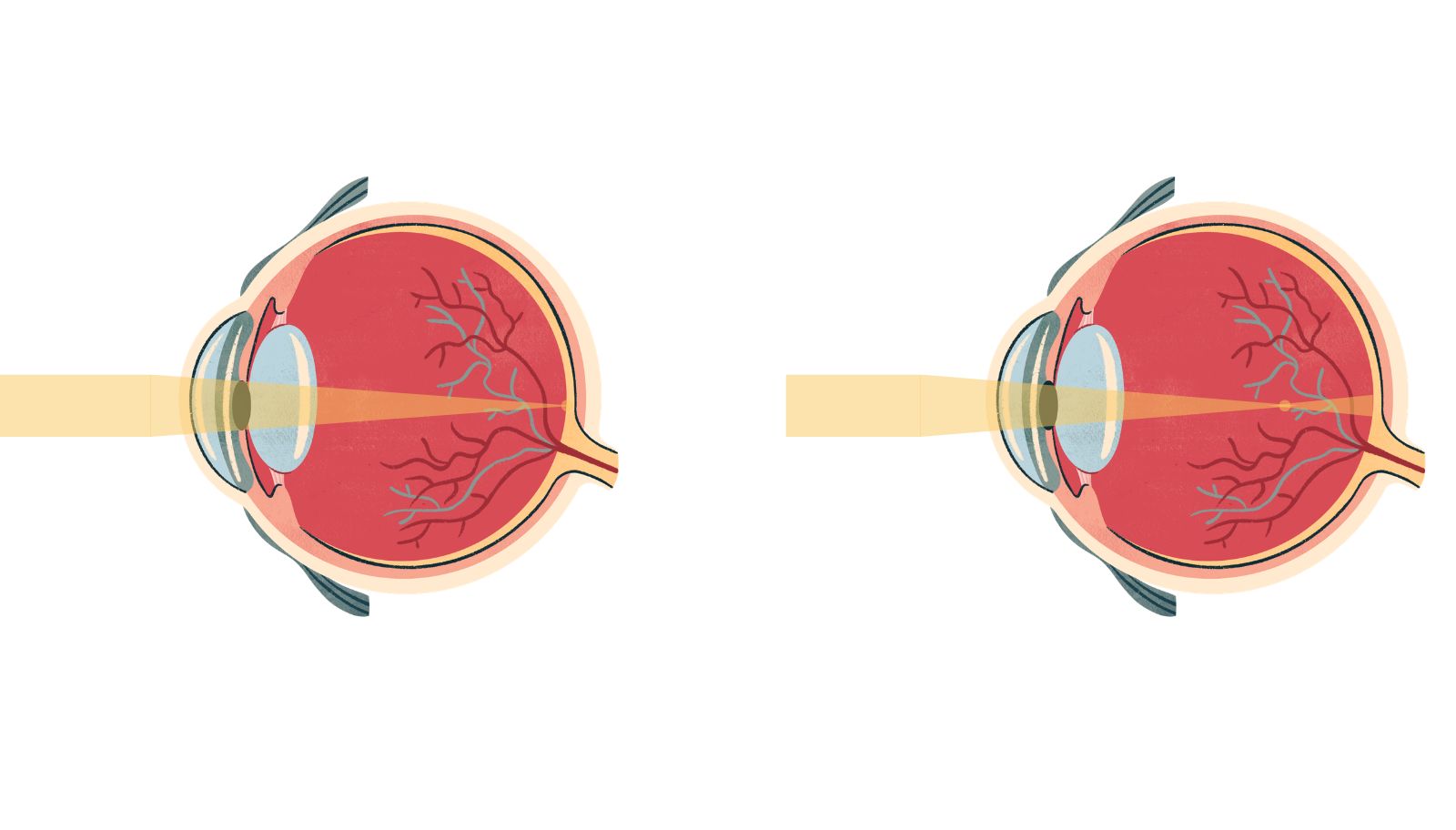 how-myopia-develops