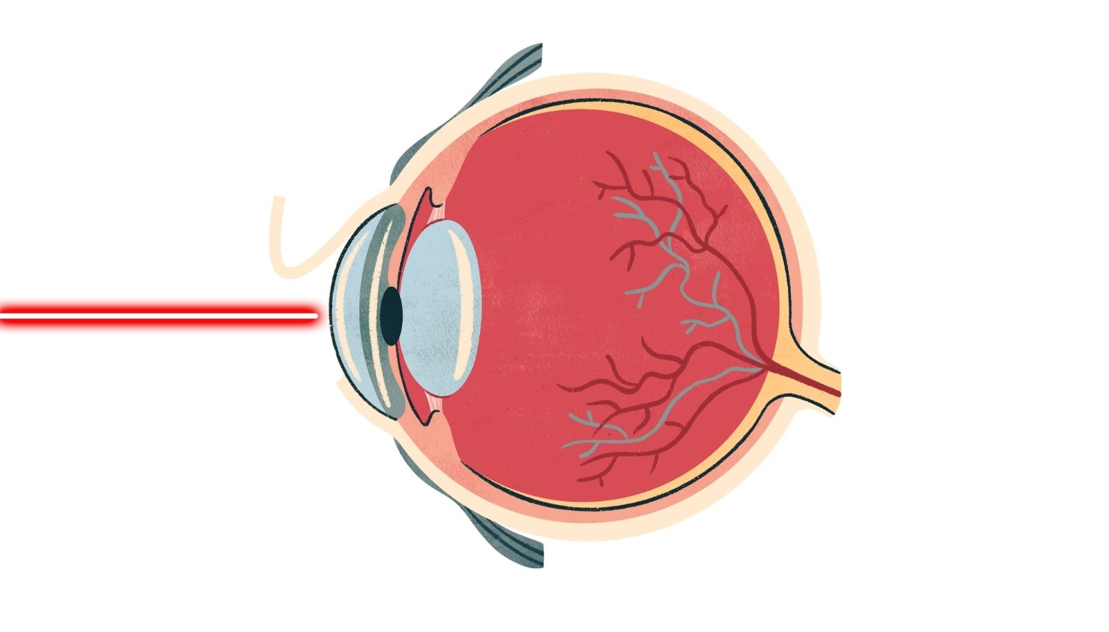 how-myopia-develops