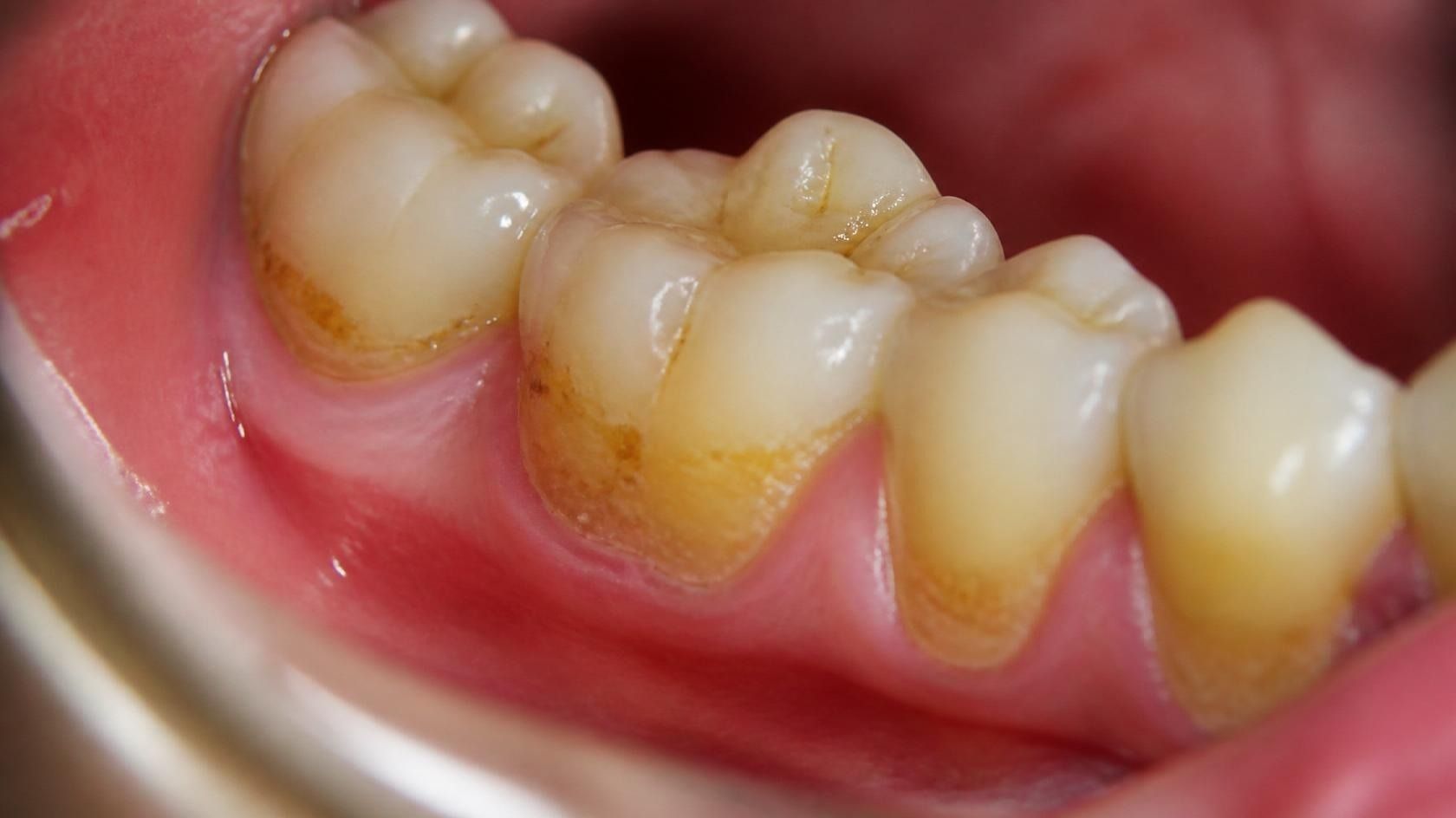 what-happens-if-you-ignore-cavities